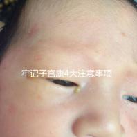 牢記子宮康4大注意事項，輕松避免胃脹、腹瀉等副作用