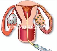 移植前內(nèi)膜厚度是否需要降調(diào)，應注意什么速度