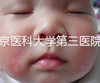 北京醫科大學第三醫院nt檢查費用盤點需要多長時間，是否預約