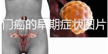 肛門癌的早期癥狀圖片(肛門有個肉球圖片)