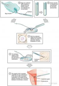 試管嬰兒移植手術(shù)（試管嬰兒移植手術(shù)需要多長時間）