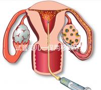 試管嬰兒一促兩移做環扎好看嗎？小心這些影響