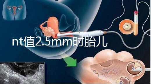 nt值2.5mm時(shí)胎兒異常幾率并不高,但羊水穿刺一定要做